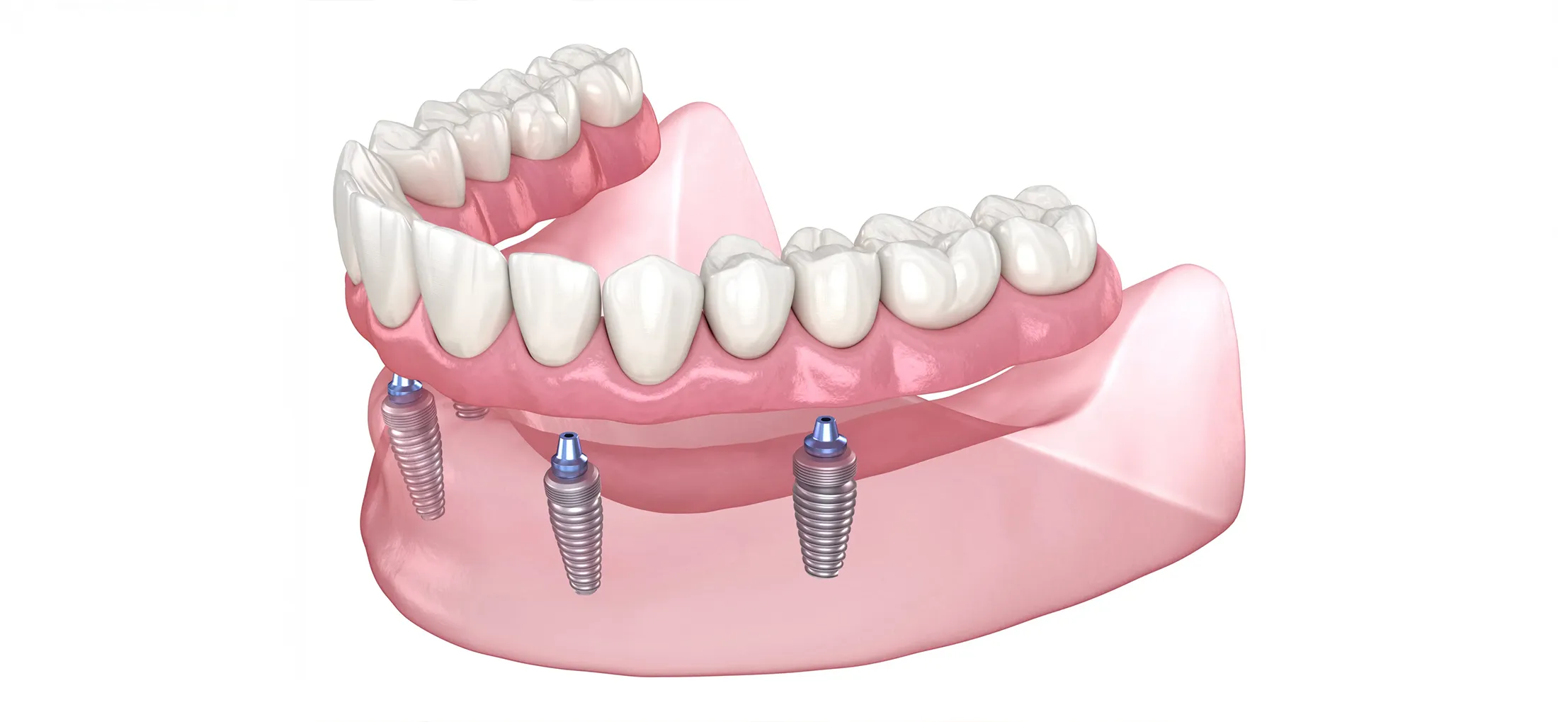 オールオン4とは