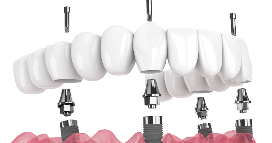 オールオン4治療