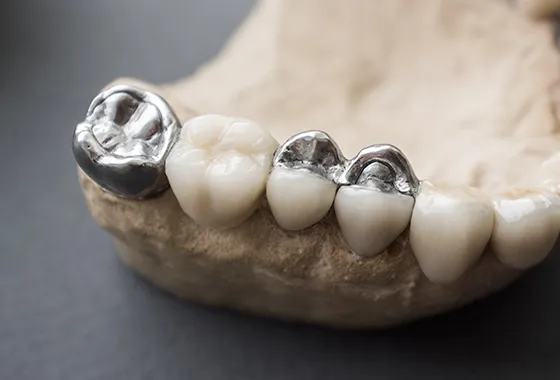 銀歯を目立たなくする