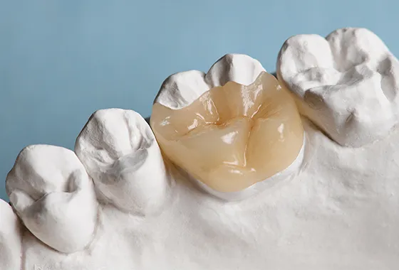 臼歯1歯の銀歯を1時間でオールセラミックに