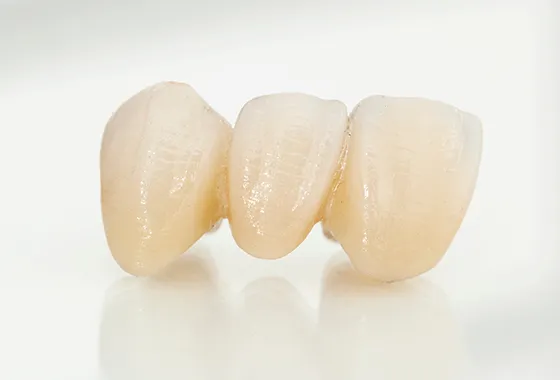 臼歯3本のブリッジを2時間でオールセラミックに
