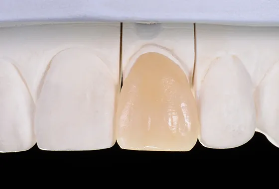 前歯1歯を1時間でオールセラミックに
