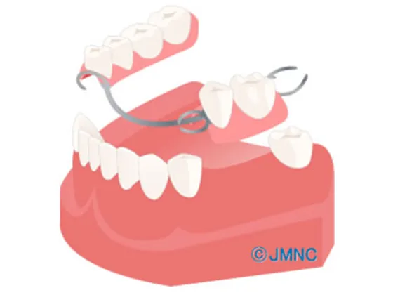 部分入れ歯