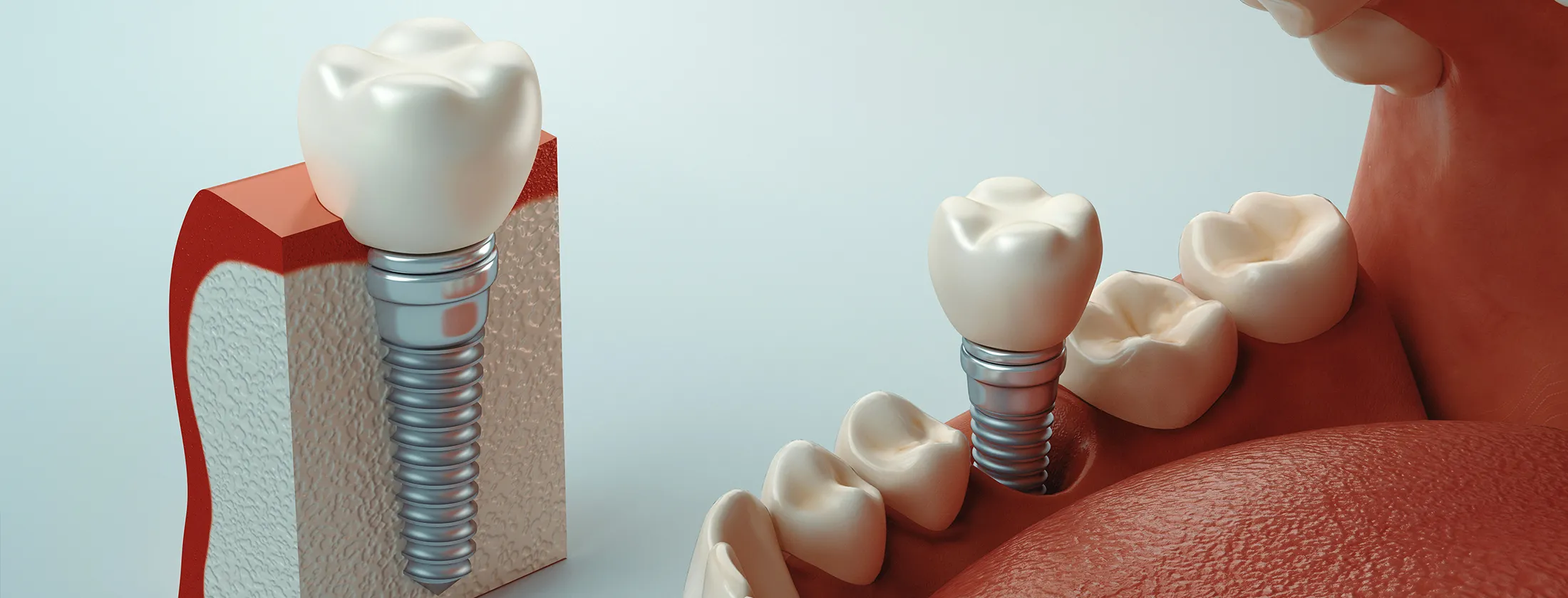 インプラントとは