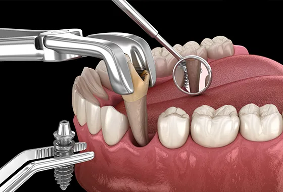 抜歯後すぐに上部構造(人工歯)まで装着可能