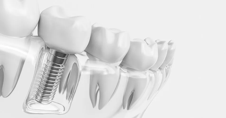 インプラント治療