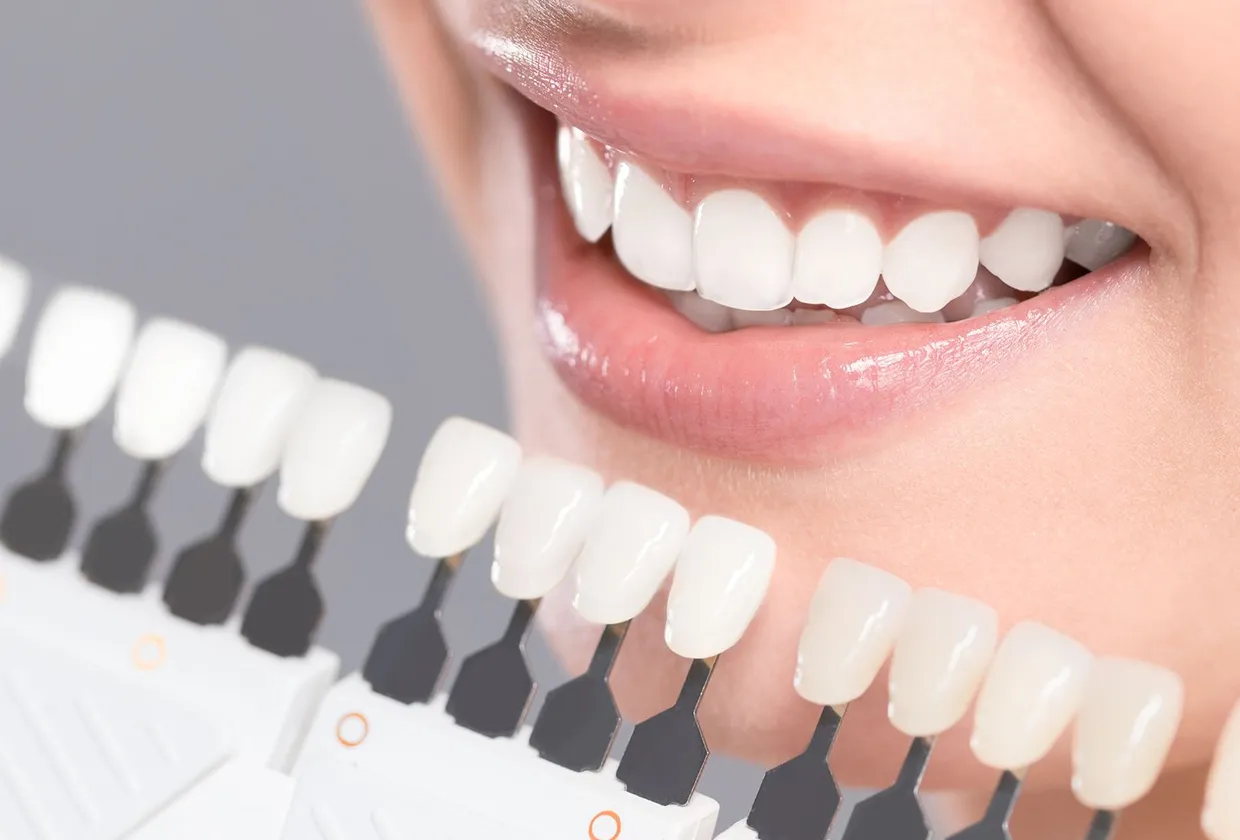 ホワイトニング