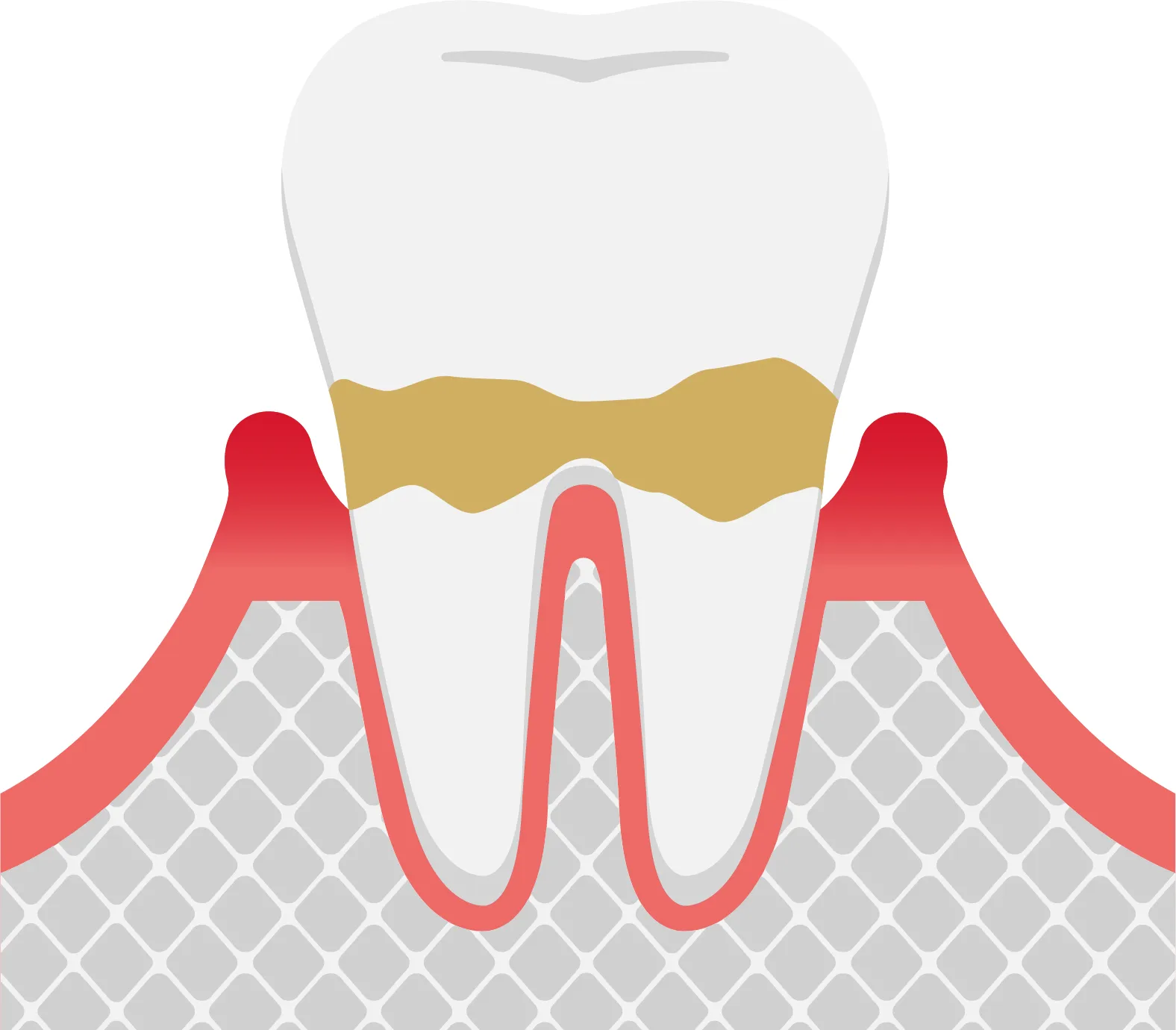 II期 軽度歯周炎