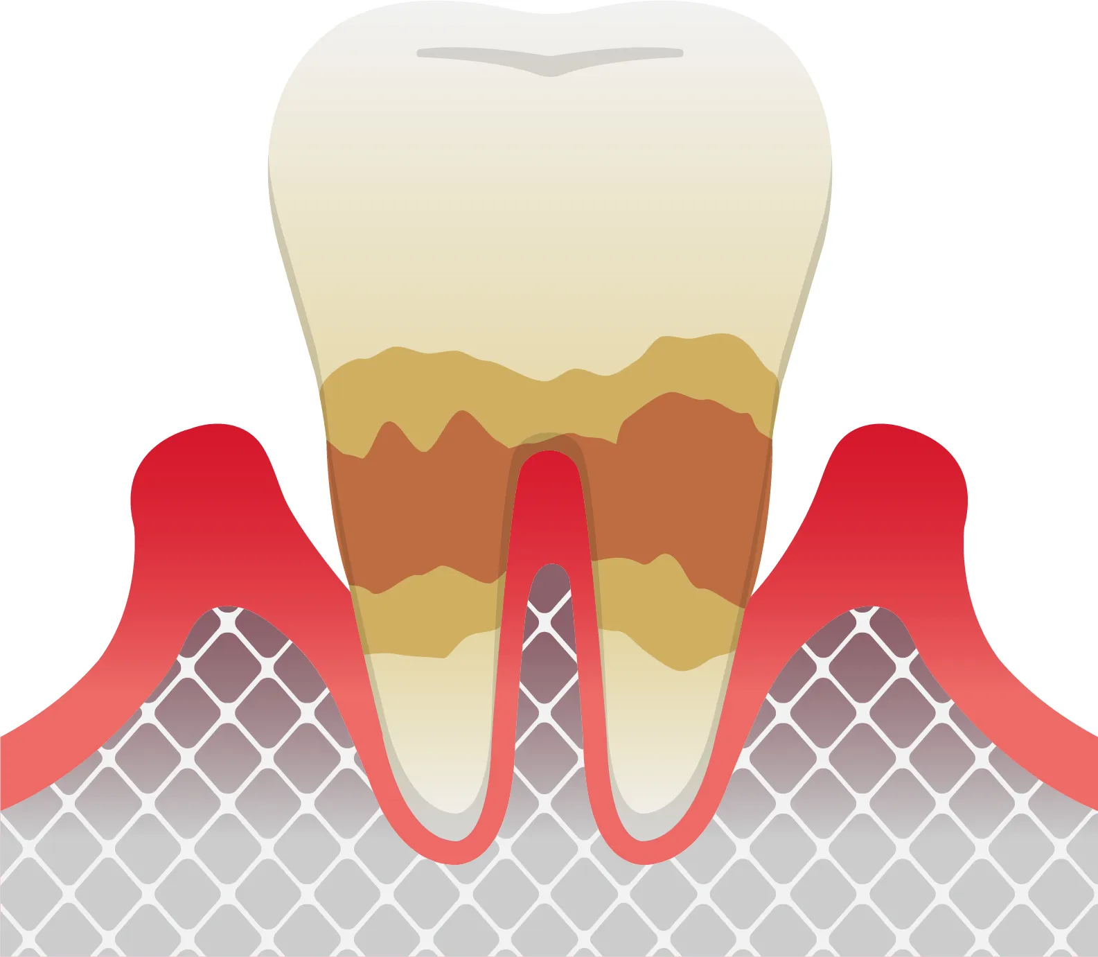 III期 中等度歯周炎