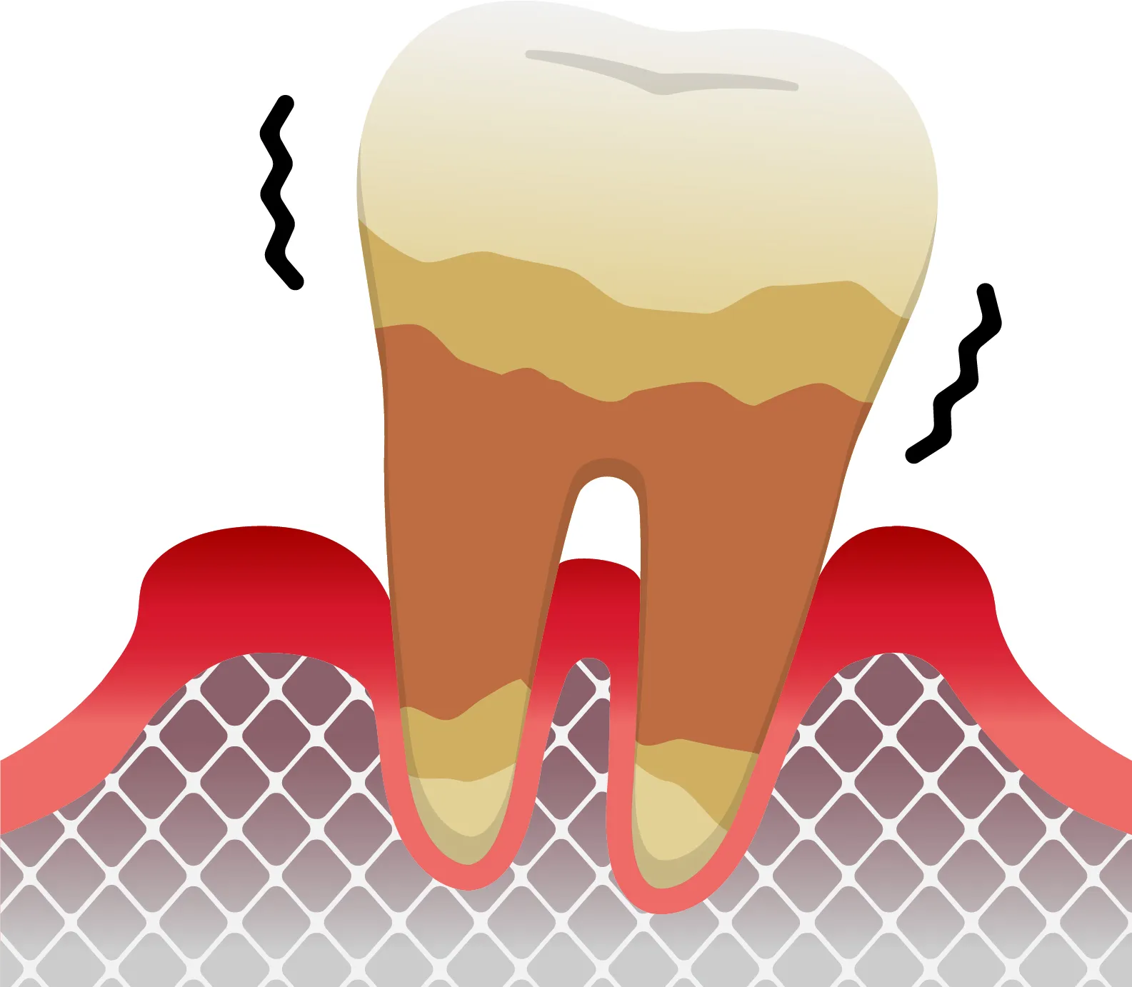 IV期 重度歯周炎