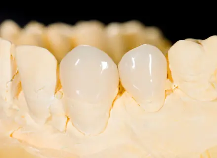 自然な美しさを再現する高度な技法〜ジルコニアフレーム＋陶材築盛とは？〜