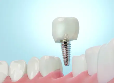歯を失ったときの選択肢 ― インプラント治療という選択