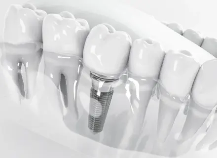 インプラント治療中に気をつけたいこと