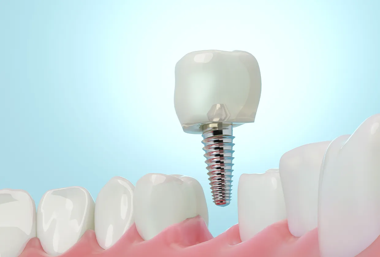 インプラント