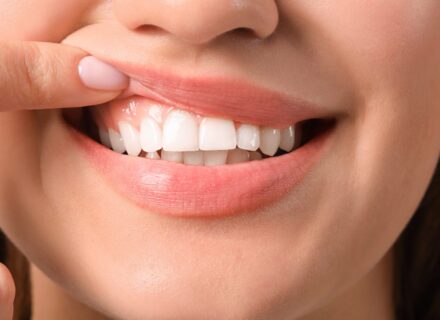 差し歯が原因の歯茎の黒ずみを改善するには？セラミック治療のススメ